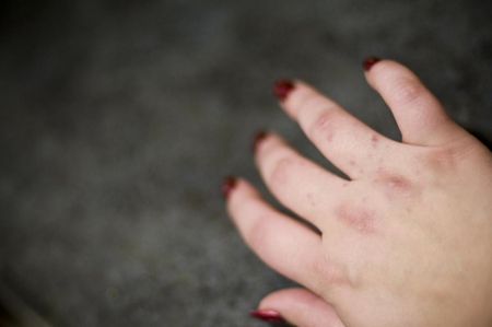 Cactus Dermatitis