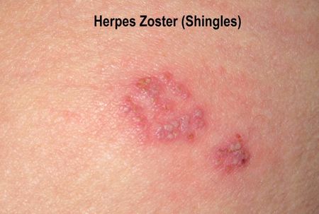 Herpes Zoster - Shingles