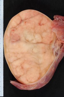Seminoma of the Testis | Source http://www. flickr. com/photos/euthman