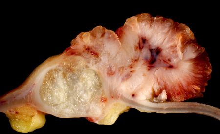 Adenocarcinoma of Ascending Colon Arising in Villous Adenoma
