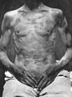 Lepra maculosa | Source last Fox | first George Henry | title Photogra