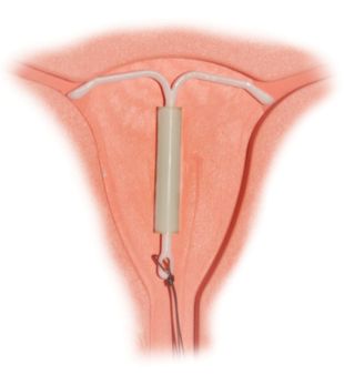 1 Mirena IntraUterine System 1 Mirena Hormonspirale | Source | Author