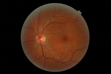 My left eye retina