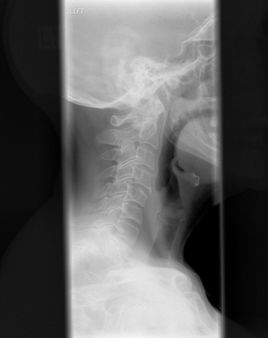 Xray of cervical spine | Source My own collection of Xrays | Date 2006