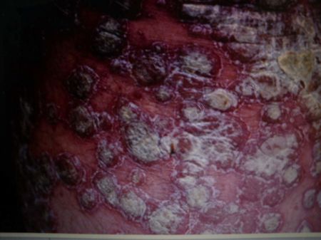 Giapponese di Sophora a neurodermatitis a