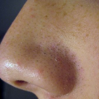 1 A picture of blackheads from a 14 year old male. | Source | Author 