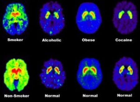 PET brain scans showing differences in the brain between addicts and n