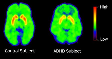 1 High Dopamine Transporter Levels Not Correlated with ADHD Contradict