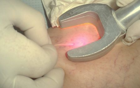 tratamiento laser para verices