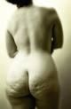CELLULITE