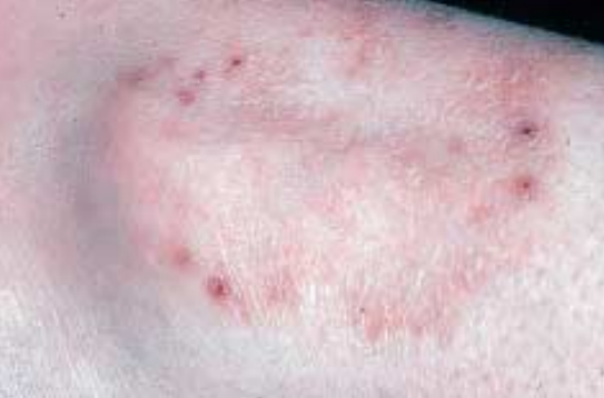 Atopitchesky la dermatite de lenfant âgé dun an