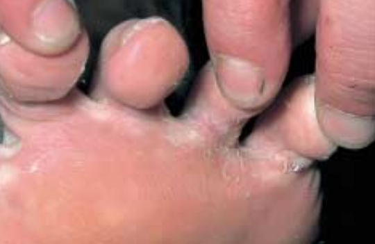 Les formes de la manifestation atopitcheskogo de la dermatite