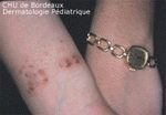 eczéma du poignet, au Nickel