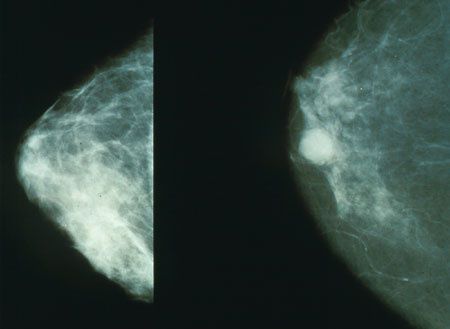 Mammo_breast_cancer.jpg
