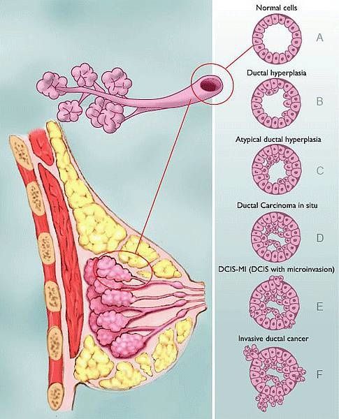 cancer-in-situ-2.jpg