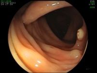 endo-polype-6--2-.jpg