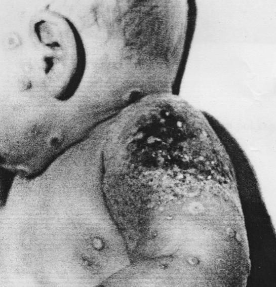 PHOTO-necrose-vaccin.JPG