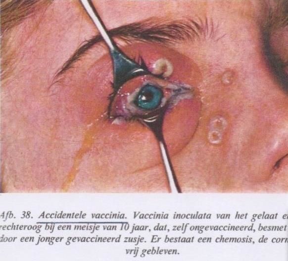 vaccinia-oeil.JPG