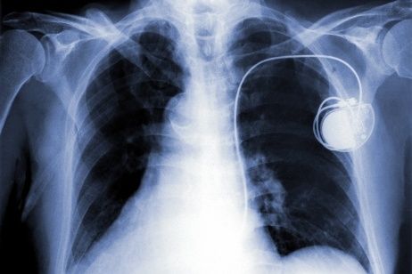 pacemaker.jpg