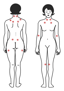 Tender_points_fibromyalgia_svg.svg.png